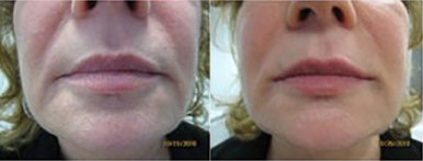 Cosmetic Fillers1