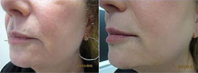 Cosmetic Fillers2