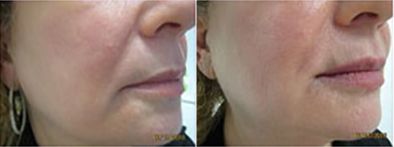 Cosmetic Fillers3