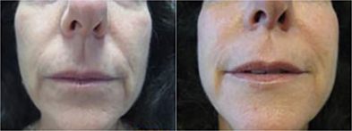 Cosmetic Fillers6