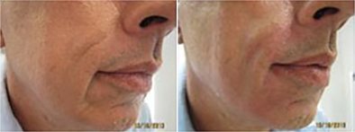 Cosmetic Fillers8