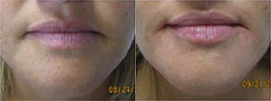 Cosmetic Fillers