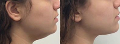 Kybella after surgery