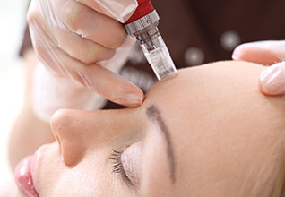 Microneedling