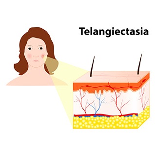 Telangiectasia